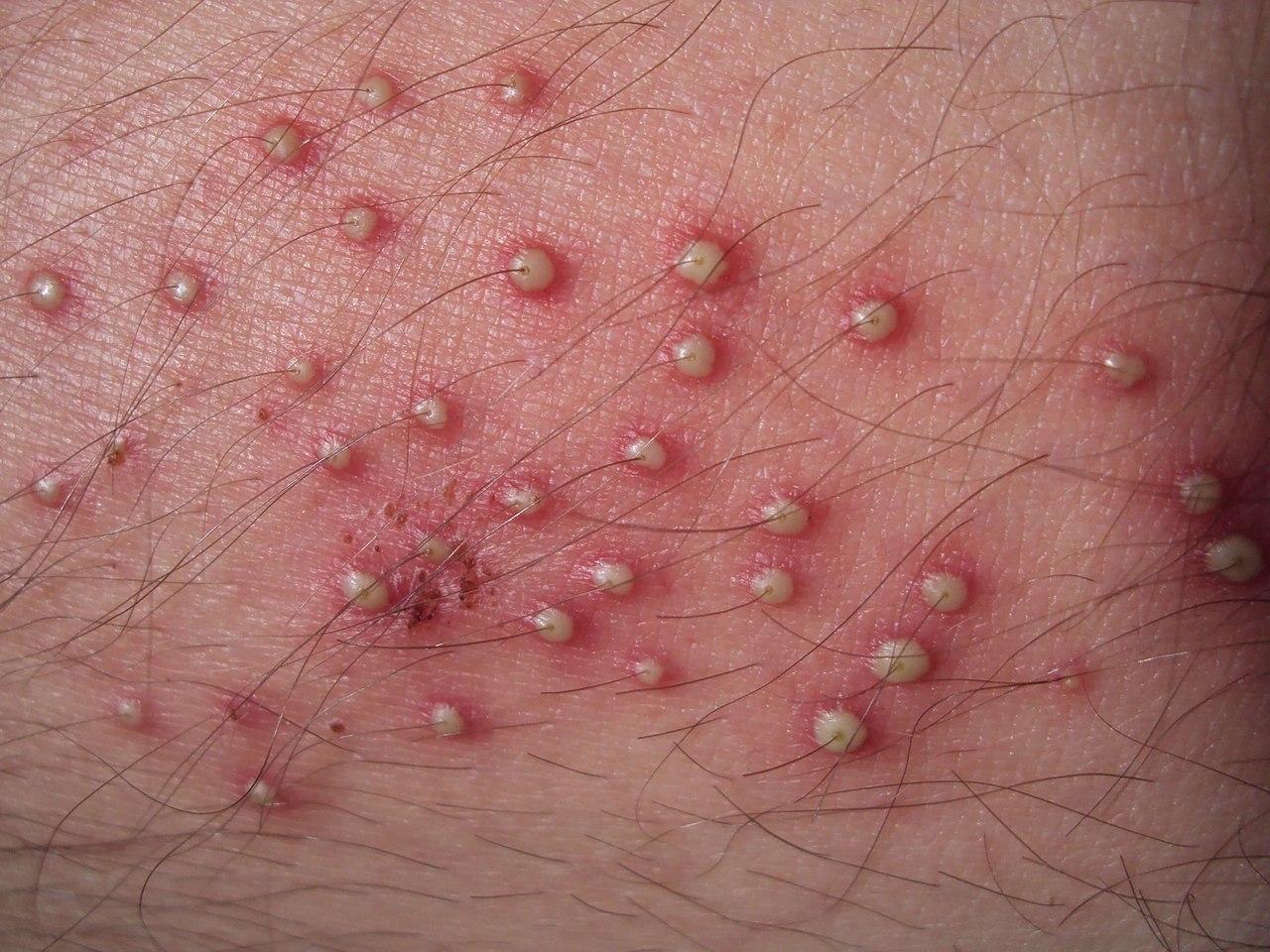 Folliculitis | Johns Hopkins ABX Guide