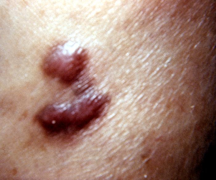 hhv 8 johns hopkins abx guide