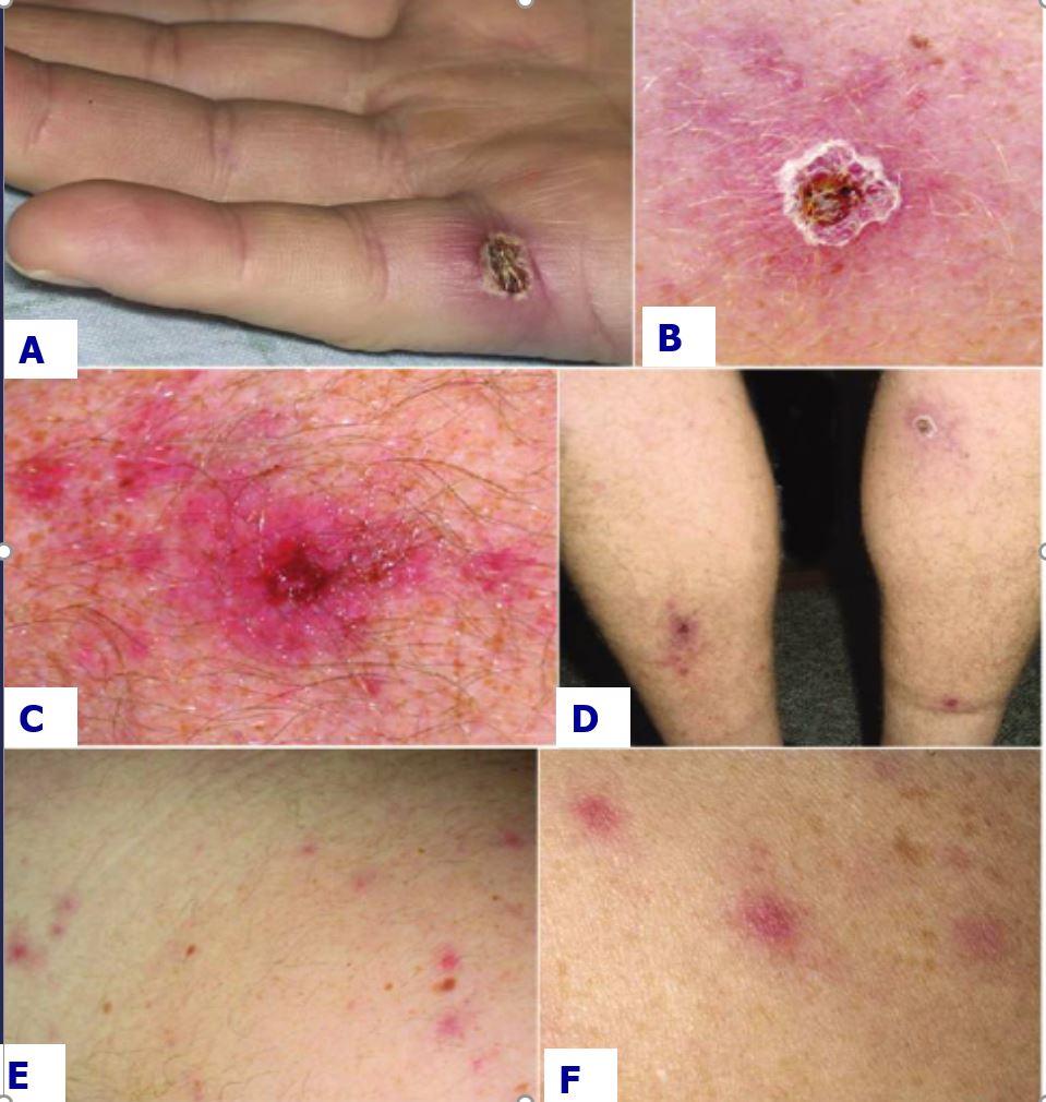 Rickettsia species | Johns Hopkins ABX Guide, image size:959x1010