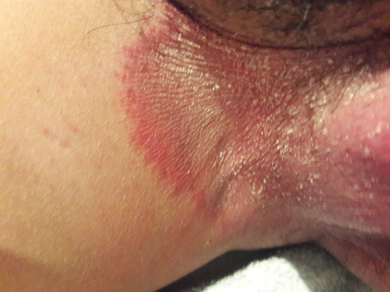Tinea Cruris Tinea Infection Treatment Types Of Tinea