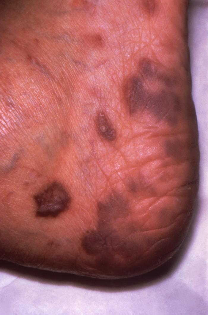 hhv 8 johns hopkins abx guide