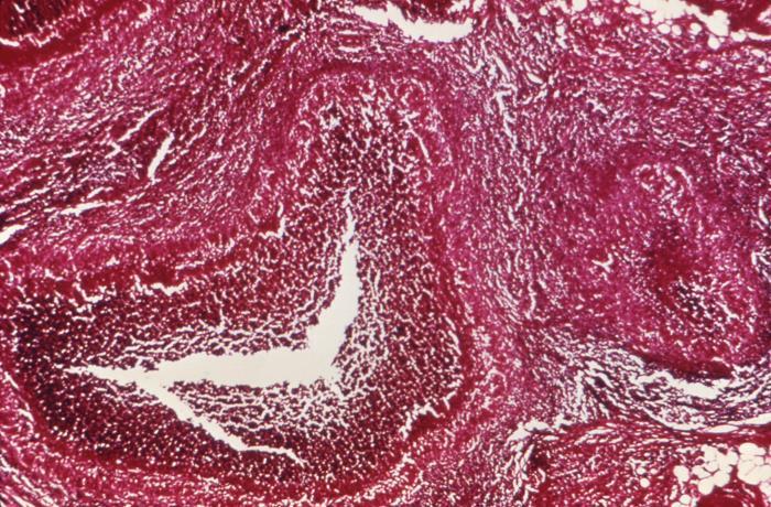 Lymphogranuloma Venereum Histology Reproduction USMLE Flashcards